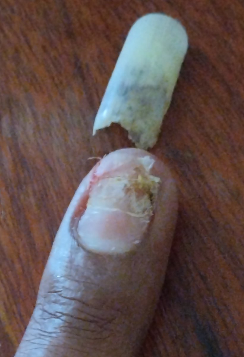 OneTowner's tweet photo. @LarryMadowo Say goodbye to that finger nail and hello to a brand new one in four months time. 
Been there. https://t.co/pTLdxtZ7FE