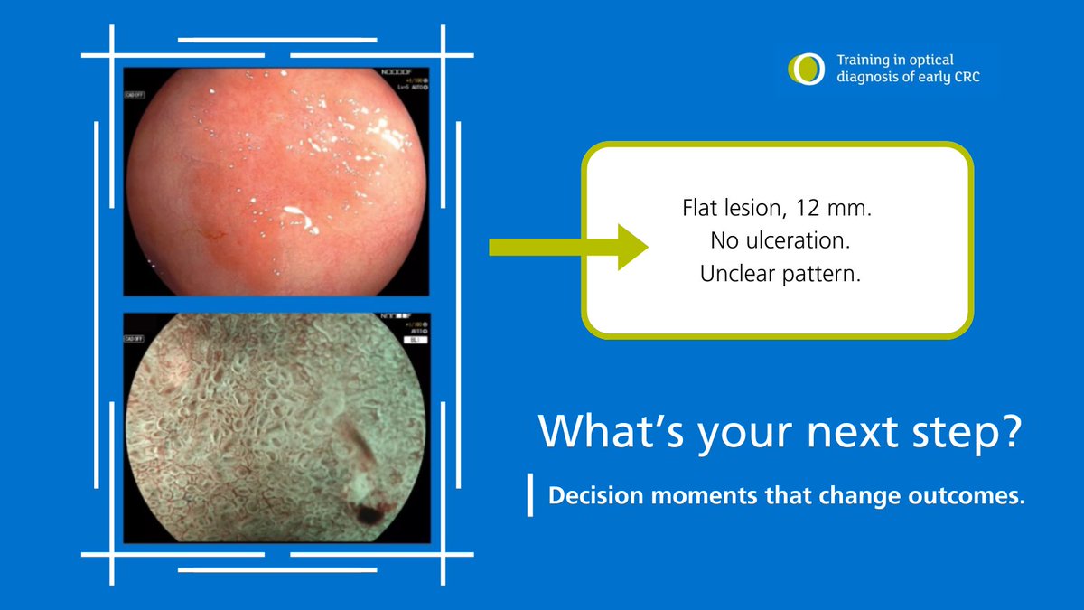 🧩 Flat lesion, 12 mm. No ulceration. Unclear pattern.

What’s your next move?

Every day, endoscopists make micro-decisions that determine whether a patient goes home… or to surgery.

The skill isn’t speed — it’s seeing what others overlook.

🎯 Explore how these decisions are