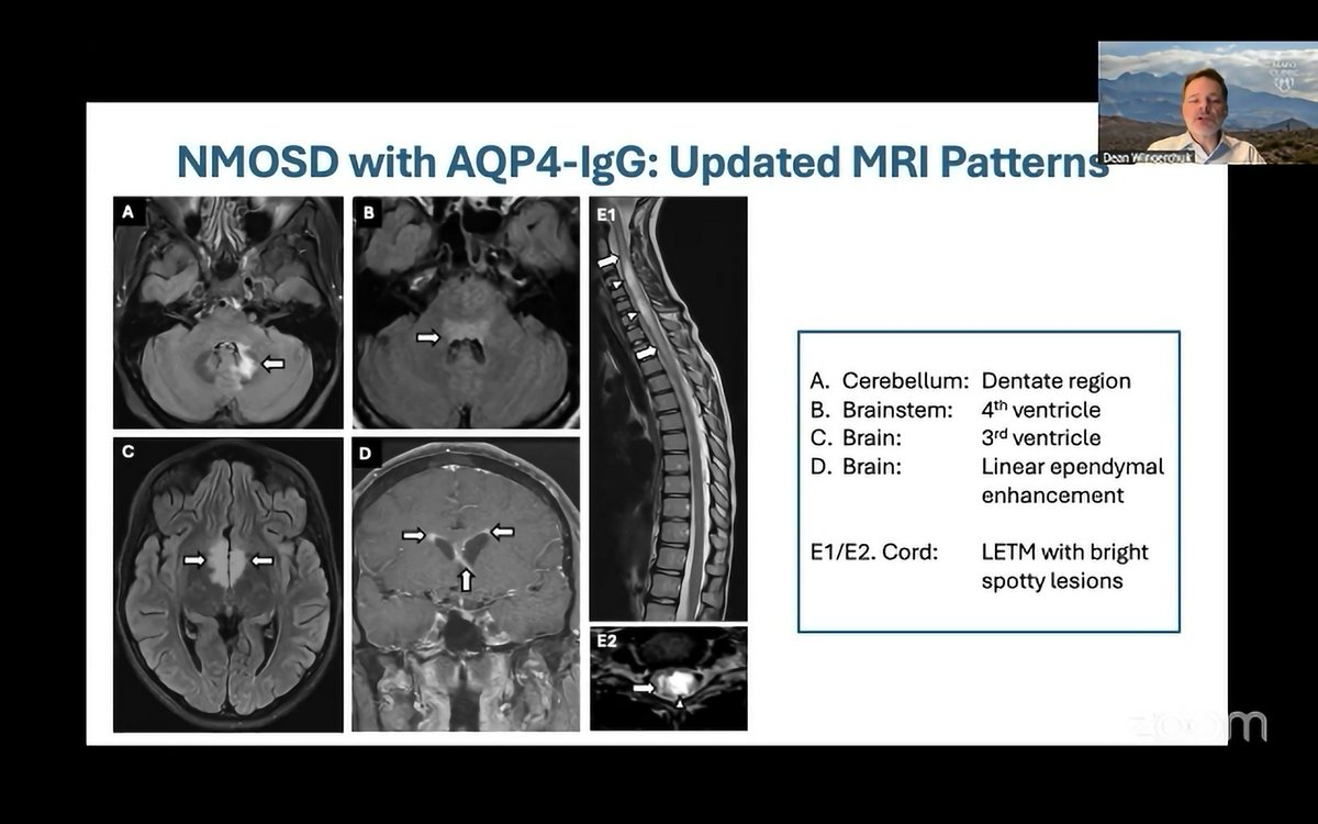 Update on IPND 2025 NMOSD diagnostic criteria presented by Dr Dean Wingerchuk via <a href="/thelimbicneuro/">the limbic</a>.

Highlights:
- New clinicorad cerebellar syndrome
- Guidance regarding AQP4 testing methods: LCBA &gt; FCBA &gt;&gt; ELISA
- Clarifying that double-seronegative phenocopies are not NMOSD