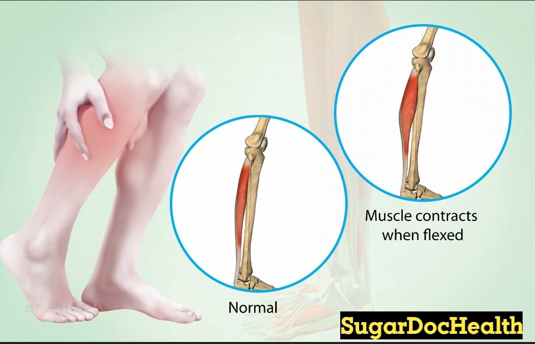 SugarDocHealth's tweet image. Have you ever woken up with your leg locked in sharp pain? That’s a 𝗖𝗵𝗮𝗿𝗹𝗲𝘆 𝗵𝗼𝗿𝘀𝗲.
A Charley horse is a sudden muscle cramp that happens when your muscle tightens and refuses to relax. These cramps can occur anywhere in the body but are most common in the legs and…