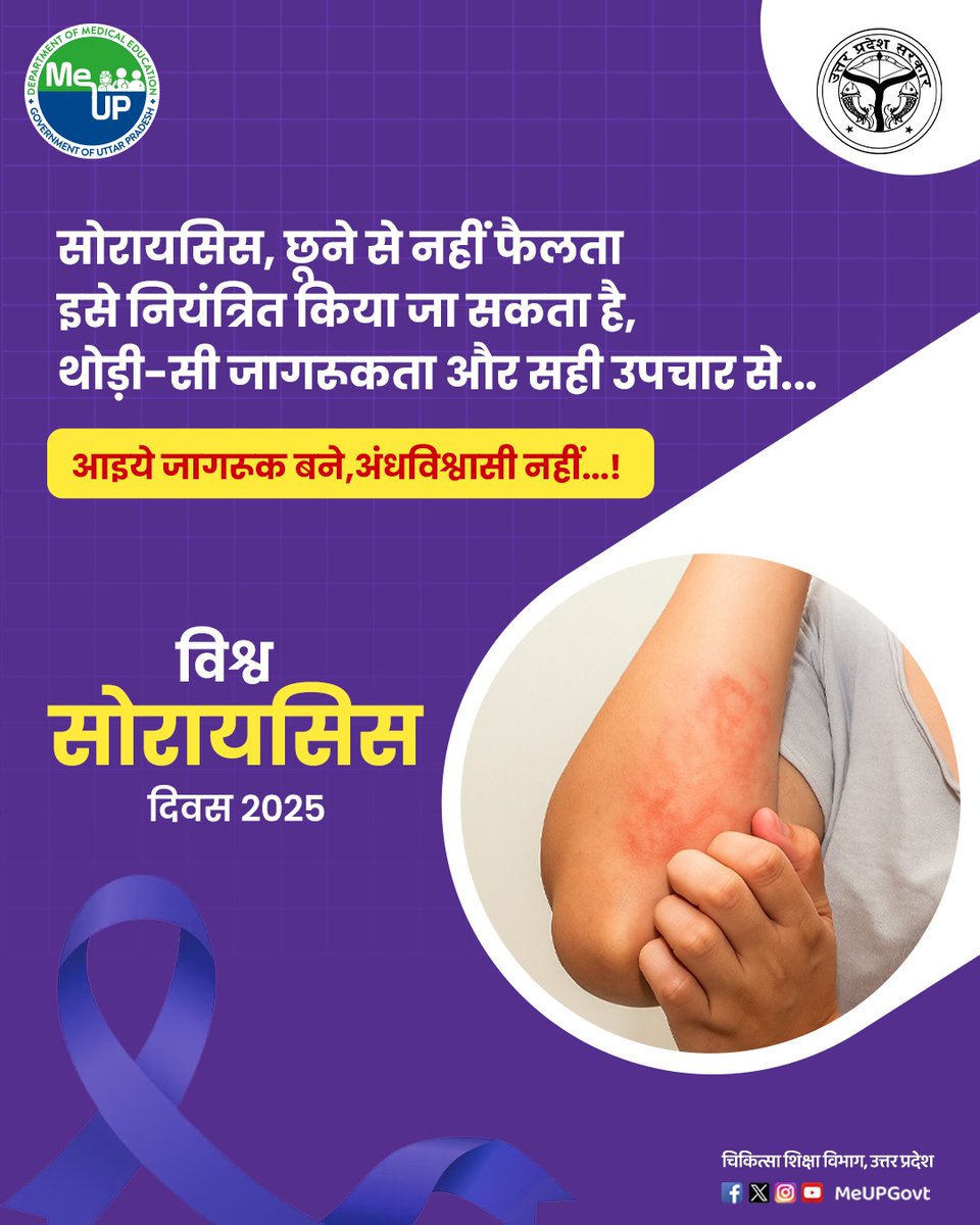 सोरायसिस छूने से नहीं फैलता। 

यह कोई संक्रामक बीमारी नहीं है। सही उपचार से इसे नियंत्रित किया जा सकता है। इसलिए जागरूक बनिए, अंधविश्वासी नहीं, सोरायसिस को समझिये डरिये नहीं! 
इस विश्व सोरायसिस दिवस 2025 पर  DGMEUP और उत्तर प्रदेश सरकार का प्रयास - हर नागरिक तक पहुँचे सही जानकारी