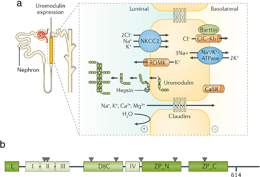 ProfSirera's tweet photo. The most abundant protein in urine isn’t waste — it’s a guardian. I am talking about uromodulin, the kidney’s secret protein with a dual identity.

🌟 Uromodulin, aka Tamm–Horsfall protein, is the most abundant protein in normal human urine — yet for decades its function remained mysterious. 

1⃣ It is produced exclusively by the epithelial cells of the thick ascending limb of the loop of Henle and released into the tubular lumen after cleavage of its glycosylphosphatidylinositol (GPI) anchor. 

2⃣ Structurally, uromodulin is a large, heavily glycosylated protein that polymerises into long filaments, forming a molecular mesh that coats the urinary tract. Its unique architecture underpins both its protective and pathological roles.

3⃣ Physiologically, uromodulin is a molecular sentinel. ▶️ Its carbohydrate side chains bind to type 1 fimbriae of Escherichia coli, preventing the bacteria from attaching to urothelial cells — effectively a “decoy receptor” defence against urinary tract infection. 
▶️ It also inhibits calcium crystal aggregation, lowering the risk of nephrolithiasis by maintaining solubility in supersaturated urine. 
▶️ Additionally, when secreted basolaterally into the interstitium, uromodulin interacts with immune cells, modulating inflammation and maintaining local tolerance.

4⃣ However, this same protein becomes pathogenic when its folding is disrupted by genetic mutations. 
▶️ In familial juvenile hyperuricaemic nephropathy (FJHN) and related uromodulin-associated kidney diseases, missense mutations in the UMOD gene cause misfolding and intracellular retention of uromodulin within the endoplasmic reticulum. 
This triggers a chronic unfolded protein response, leading to tubular cell stress, interstitial fibrosis, and progressive renal failure. 
The associated hyperuricaemia arises from impaired sodium and urate handling in the thick ascending limb.

5⃣ Uromodulin thus embodies a molecular duality: 
▶️ When properly folded and released, it shields the kidney from infection and crystal injury.
▶️ When misfolded and trapped, it slowly destroys it from within. 

6⃣ Current research explores whether serum uromodulin levels can serve as a biomarker of nephron health — a secret from the kidney that may help diagnose its own decline.

Its story also exemplifies how the same molecule can link innate immunity, tubular transport physiology, and genetic disease into a single molecular narrative. 

#Physiology_RS #Nephro_RS 
#Physiology #Nephrology