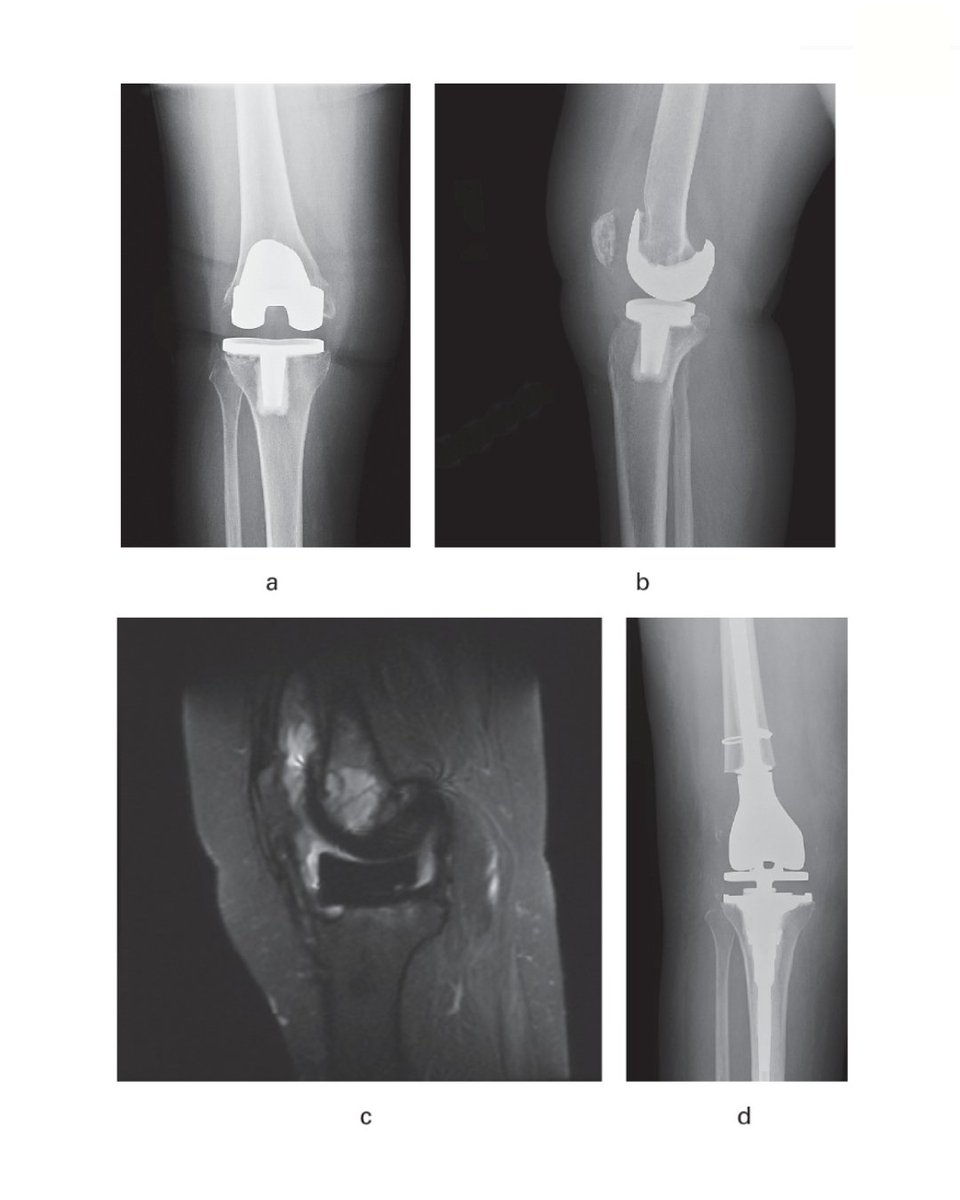 "This study, along with the recent recall of the implant, confirms the need for frequent monitoring of patients with Optetrak TKAs...".

#TKA #TotalKneeArthroplasty #KneeReplacement <a href="/bethgausdenmd/">Elizabeth Gausden</a> <a href="/HipKneeDocNYC/">Geoffrey Westrich</a> <a href="/DrPeterSculco/">Dr. Peter Sculco</a> <a href="/BrianChalmersMD/">Brian Chalmers</a>

ow.ly/ANwo50Xiqoe