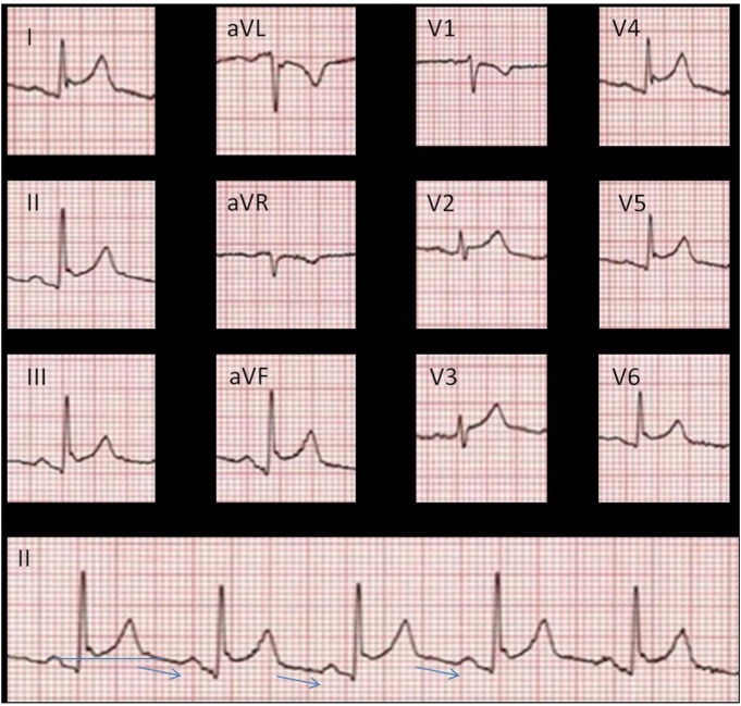 TrackYourHeart's tweet image. What is the characteristic ECG feature of Spodick’s sign?
a) ST-segment elevation
b) PR-segment elevation
c) Downsloping TP segment
d) QRS widening