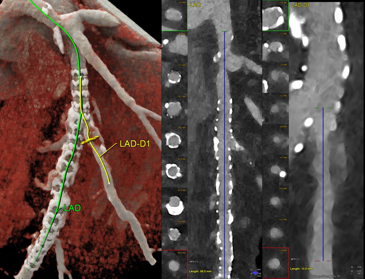 🩻 Dual-Source Photon-Counting CT for In-Stent and Bifurcation Imaging: Bridging the Gap with Intravascular Modalities

Assessing coronary stents and adjacent bifurcations has traditionally required invasive intravascular imaging such as IVUS or OCT to overcome the limitations of