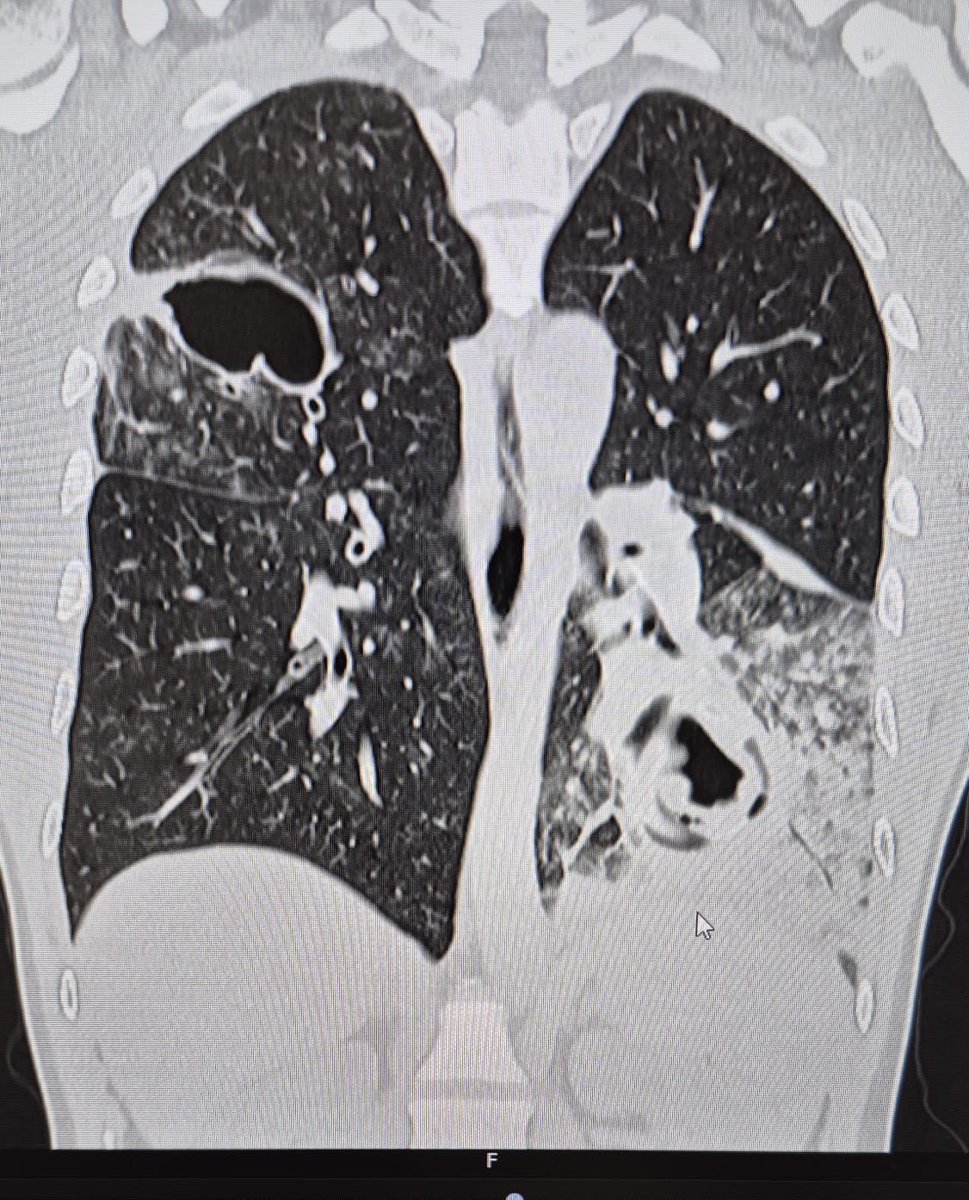 Bilateral VATS had been performed in a single sesion for multiple hydatid cysyts.