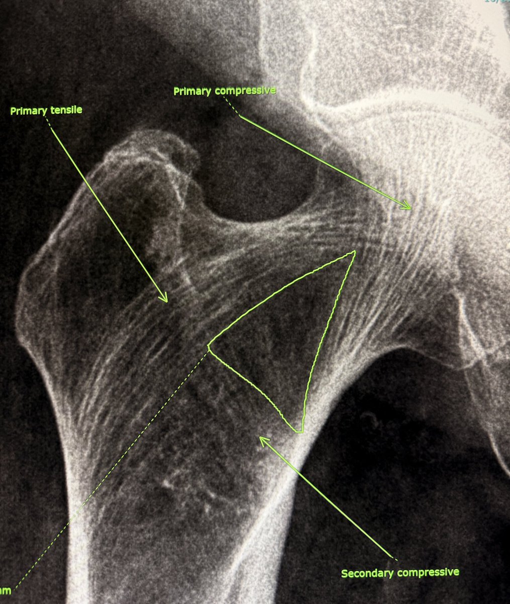 Nothing fancy today! 

Elderly lady with ground level fall. 

Just a beautiful reminder of geometry in anatomy.  Ward’s triangle is a radiolucent zone framed by the femur’s principal compressive, secondary compressive, and tensile trabeculae, a quiet masterpiece of natural