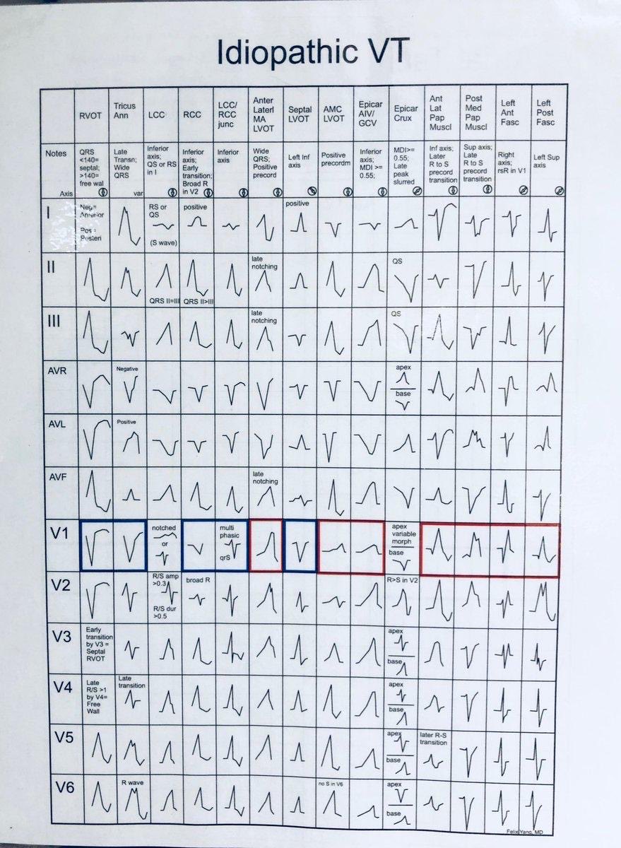 🔍Esquema de localización de Taquicardia Ventricular 👇🏼