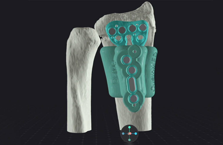 CustoMED raised $6M to scale its AI-powered orthopedic platform, integrating automated 3D printing for patient-specific surgical guides and implants. Used in hundreds of surgeries, the cloud-based system streamlines imaging to OR workflows, supporting quality and safety. Funds