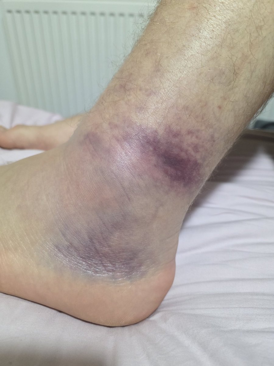 ExitLeft_'s tweet image. People who say running us good for you is fucking lying 🤣