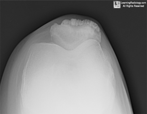 Knee Skyline Laurine view 
Patella tooth sign of quadriceps enthesopathy.