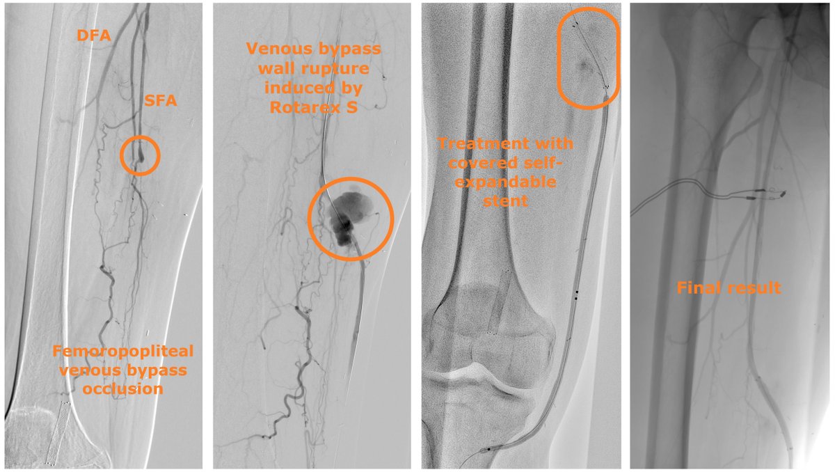 CLIjournal's tweet image. Treatment of Arterial Wall Rupture Induced by a Rotational Atherothrombectomy Device
The authors report 2 cases of vessel preparation where the Rotarex S Rotational Excisional Atherectomy System (BD) induced arterial wall ruptures.  
hubs.ly/Q03QhCcF0