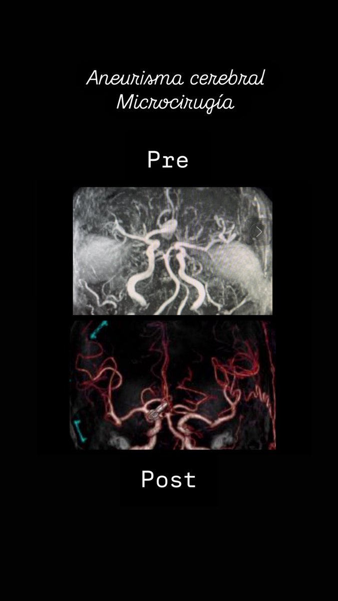 DROSCARZORRO's tweet image. La microcirugía sigue siendo una opción terapéutica válida en el manejo de los aneurismas cerebrales. La técnica de Clípaje es válida.