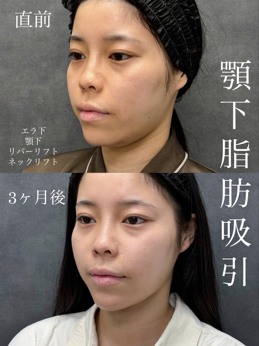 dr__kiya's tweet photo. 他院で脂肪吸引歴があり再施術の3ヶ月後症例です。
☑︎顎下ペタっとしたい方は顎下の糸リフトも併用するととても良いです。
☑︎再施術の場合内部が瘢痕化して難易度が高くなるのでドクター選びがかなり重要です。
他院修正や再施術も多数担当してますのでご相談ください🙇‍♀️
#大阪 #リバークリニック https://t.co/3BFJ2CDAyS