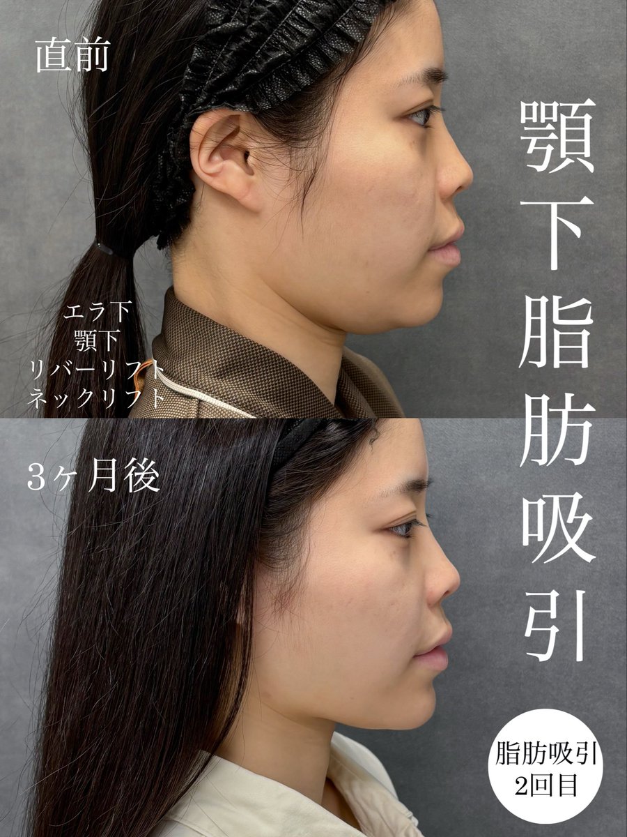 dr__kiya's tweet photo. 他院で脂肪吸引歴があり再施術の3ヶ月後症例です。
☑︎顎下ペタっとしたい方は顎下の糸リフトも併用するととても良いです。
☑︎再施術の場合内部が瘢痕化して難易度が高くなるのでドクター選びがかなり重要です。
他院修正や再施術も多数担当してますのでご相談ください🙇‍♀️
#大阪 #リバークリニック https://t.co/3BFJ2CDAyS