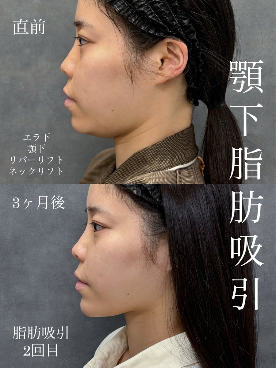 dr__kiya's tweet photo. 他院で脂肪吸引歴があり再施術の3ヶ月後症例です。
☑︎顎下ペタっとしたい方は顎下の糸リフトも併用するととても良いです。
☑︎再施術の場合内部が瘢痕化して難易度が高くなるのでドクター選びがかなり重要です。
他院修正や再施術も多数担当してますのでご相談ください🙇‍♀️
#大阪 #リバークリニック https://t.co/3BFJ2CDAyS