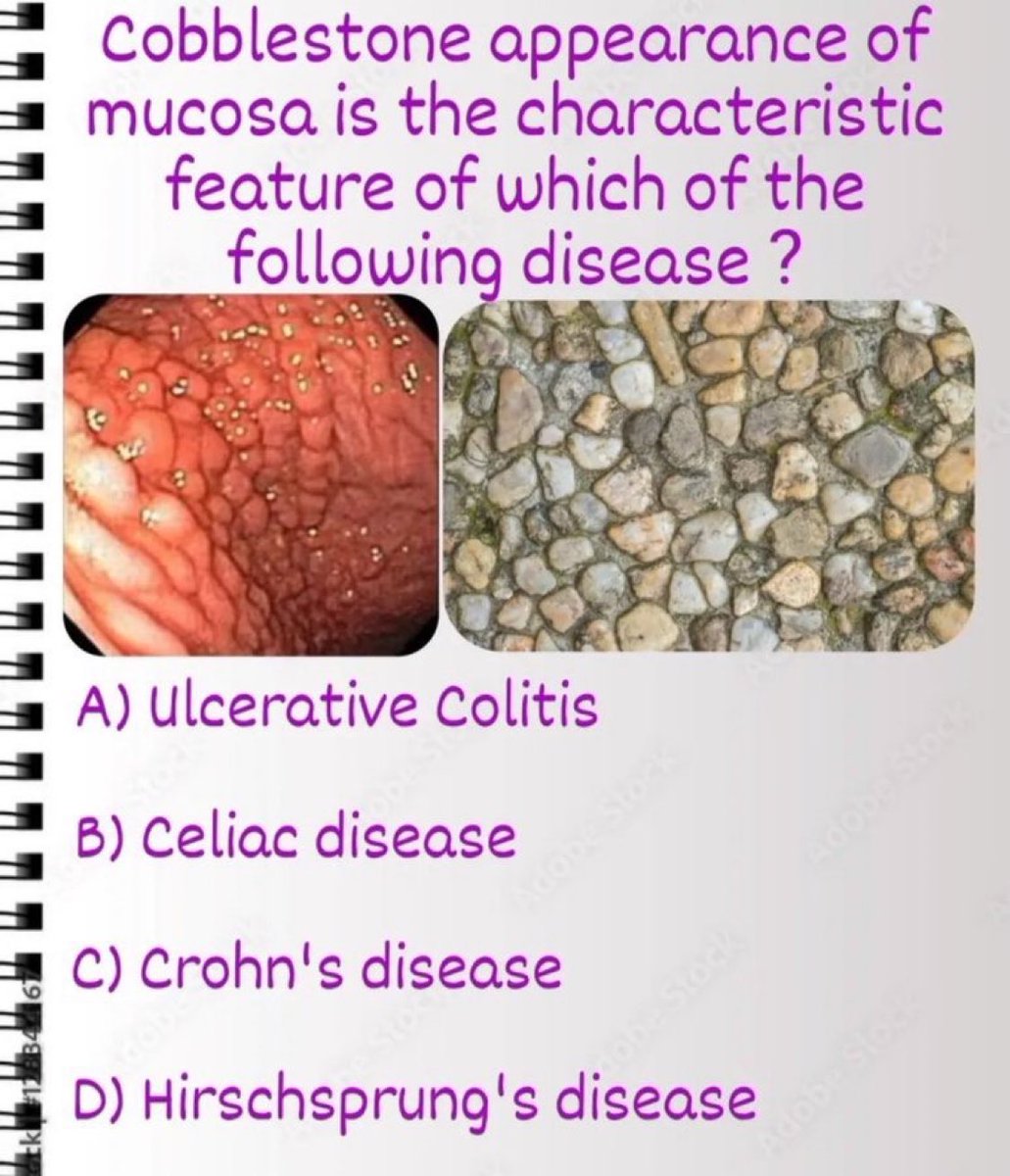 Cobblestone appearance of mucosa is the characteristic feature of which of the following disease?