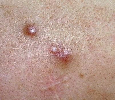 Wellness Wednesday💡

Did you know breast cancer can spread to the skin (cutaneous metastasis) — often as a sign of advanced disease?

Watch out for:
🔸 New lumps on the skin
🔸 Dimpling or thickening
🔸 Redness or rash that won’t go away

Early checks save lives
 #BreastCancer