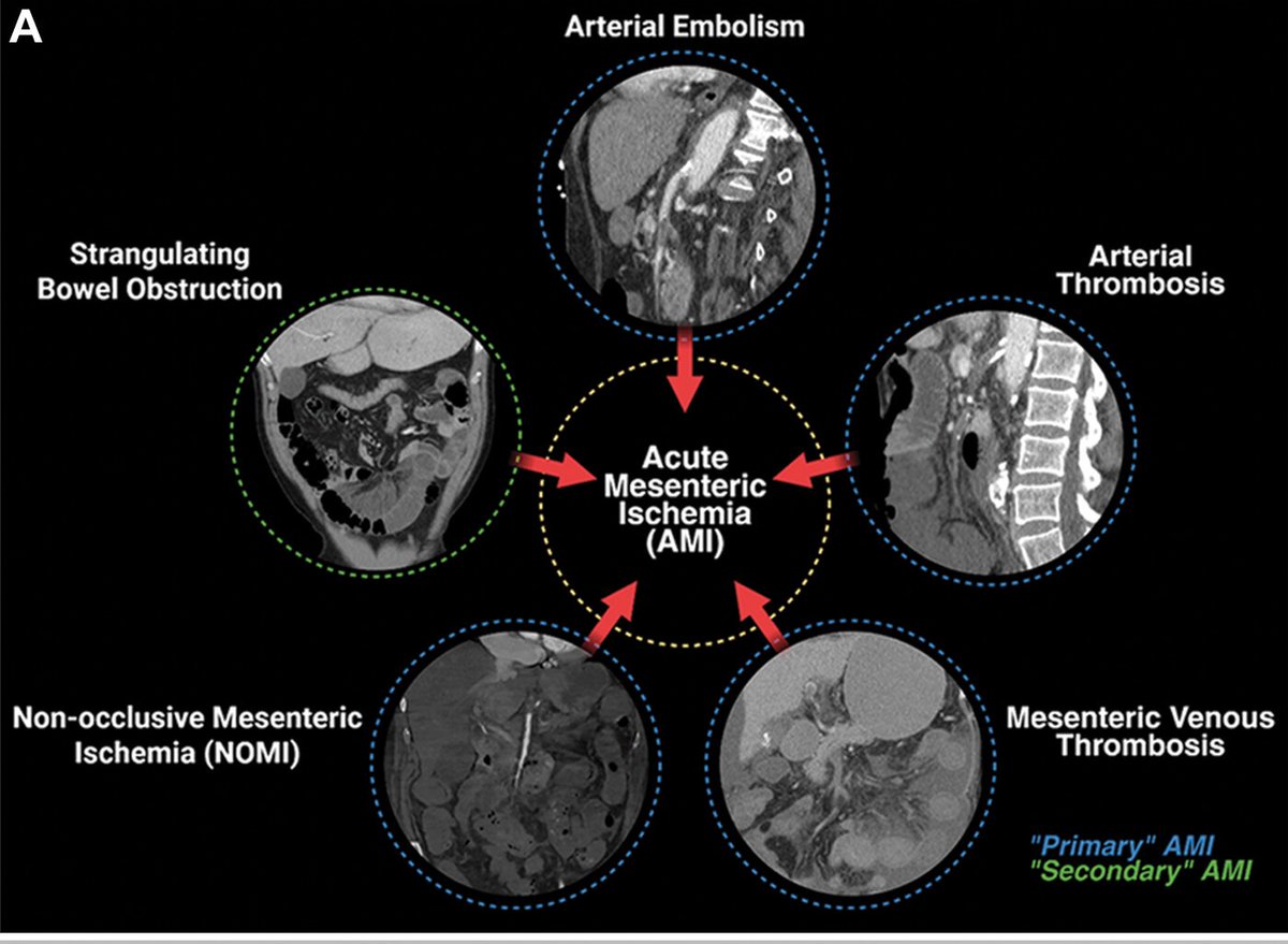 In acute mesenteric ischemia, time is everything. CT angiography is your go-to — before the labs reveal it and it’s too late. bit.ly/43uY0q4