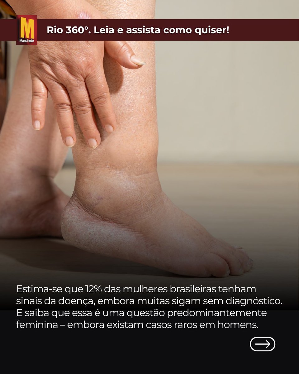 Manchete_360's tweet photo. Uma vez detectado o problema, a boa notícia é que há tratamento para o lipedema!

Saiba mais sobre o assunto na matéria completa no nosso site ou Youtube! https://t.co/RSjdlKondt