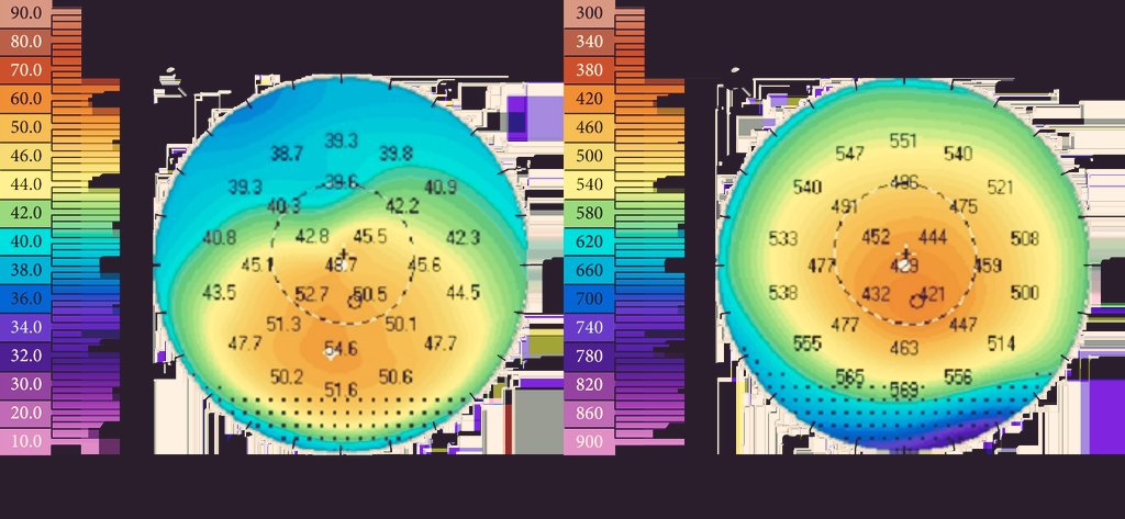 Optomedicare's tweet image. This week in our visual health episode we shine light to #keratoconus as one of the progressive corneal disorders that contribute to visual #impairement.

Understanding it is pertinent to shaping the right decisional approach timely. 

#BetterTogether 
#EyeHealthToday