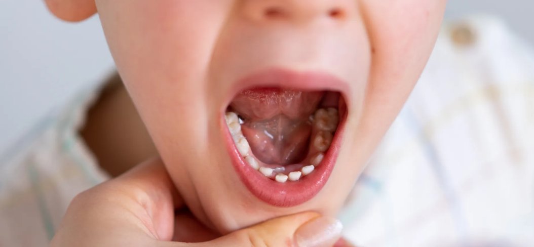 drdrumi's tweet photo. 🦷 Baby teeth serve as "guides" for permanent teeth. Premature loss or decay of baby teeth can affect the position of permanent teeth. 🦷 #DentalProtection #Science https://t.co/uuon0Dorne