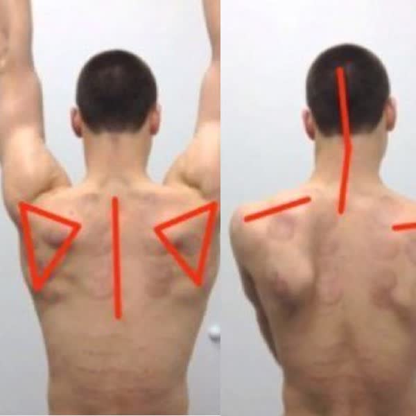 Assessing Overhead Arm Elevation - Video Case Study #DPTstudent mikereinold.com/assessing-over…