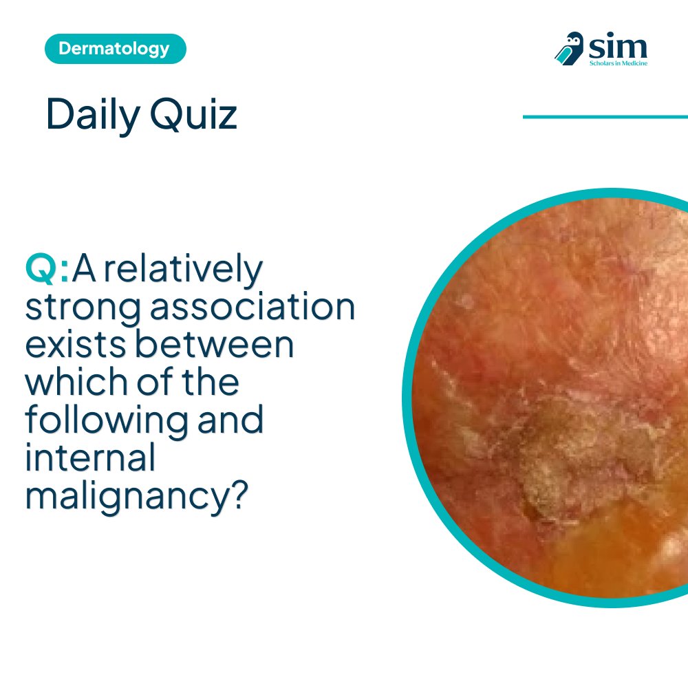 scholarsinmed_'s tweet image. 💡 Derm Quiz:
Which condition has a strong link to internal malignancy?
A️ Bullous pemphigoid
B️ Bullous pemphigus
C️ Mucous membrane pemphigoid
D️ Ocular cicatricial pemphigoid

Answer here:
👉 scholarsinmedicine.com/dashboard?quiz…

#Dermatology  #MedicalEducation #Pemphigus #MedTwitter