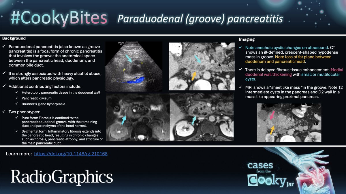 Answer: Paraduodenal Pancreatitis (Groove Pancreatitis)

Learn more: Pancreaticoduodenal Groove: Spectrum of Disease and Imaging Features|doi.org/10.1148/rg.210…

#CookyBites #237 #RGphx <a href="/cookyscan1/">Cooky Menias</a> <a href="/RadioGraphics/">RadioGraphics</a>