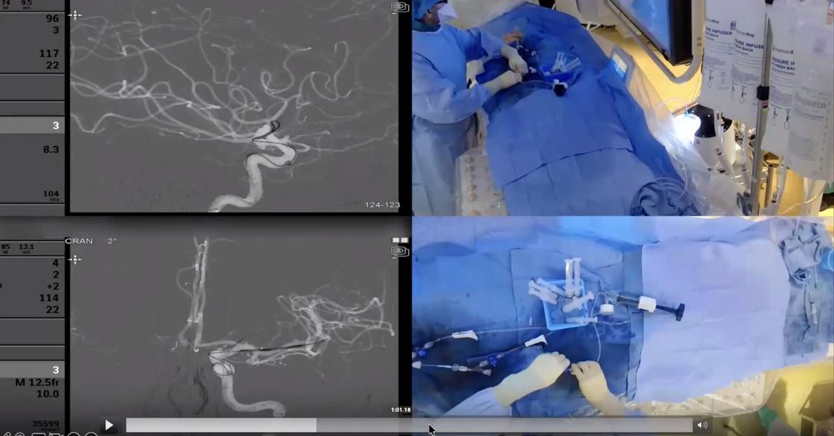 Dr. Brijesh Mehta discussing the impact of tele-training through Mission Thrombectomy’s Tele-Observership — advancing global stroke care through shared learning. #WorldStrokeDay #Telemedicine #StrokeCare