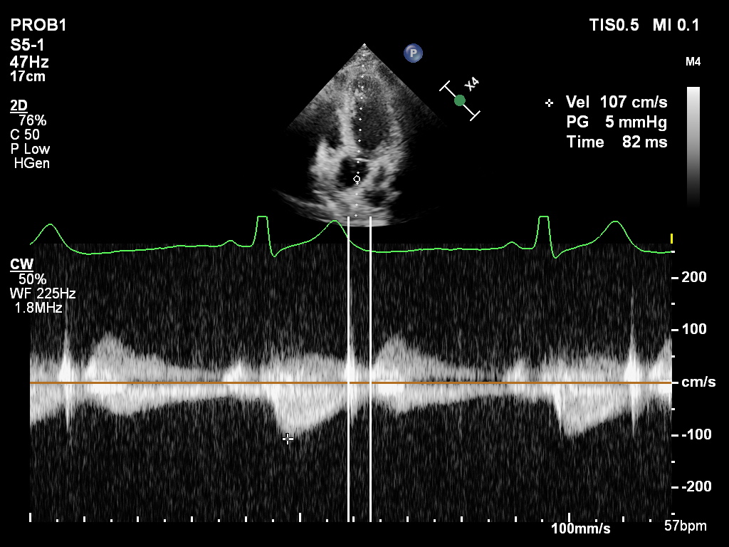 musti99617's tweet image. 24 y.o male, ejection fraction %40 after anterior infarction. E/A: 2,6 e': 11  IVRT: 82 msn diastolic dysfunction? @JaeKOh2 @AJamilTajik @EchoSoliman @DonalErwan @denisamuraru @PPibarot