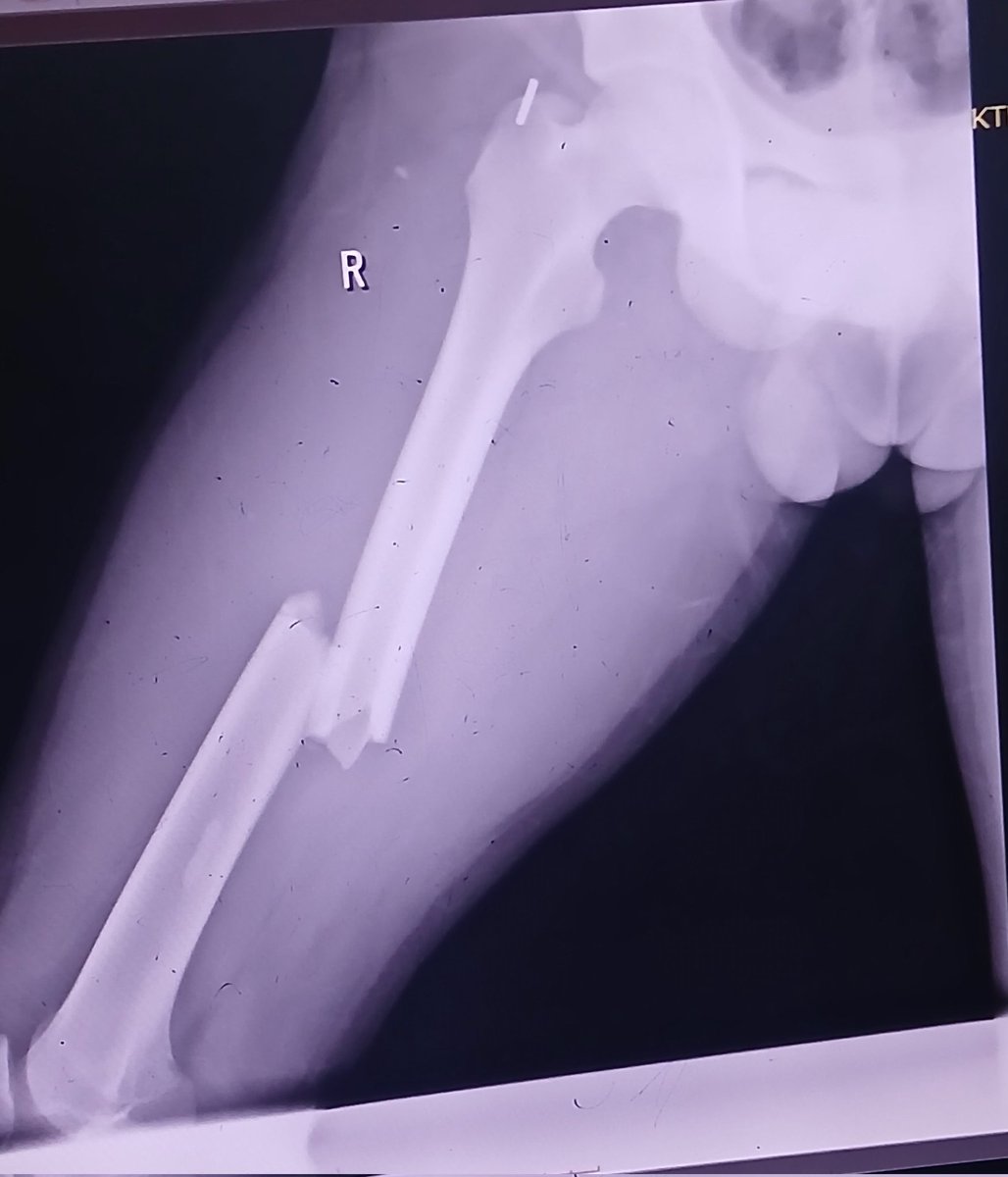 DoctorWoctor_'s tweet image. Some bone fixation 🙄
#Orthopedics #Trauma #InterlockingNail #Femur #Humerus
