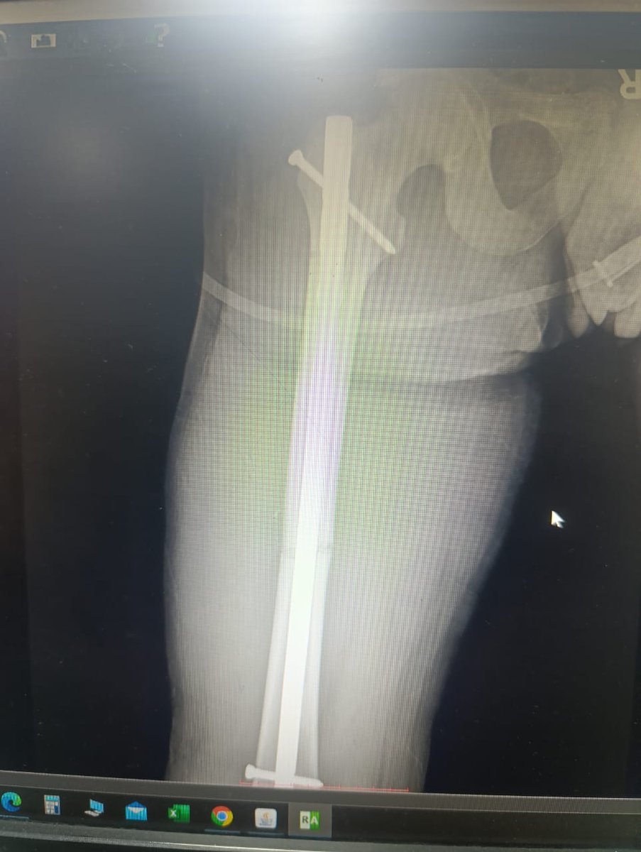 DoctorWoctor_'s tweet image. Some bone fixation 🙄
#Orthopedics #Trauma #InterlockingNail #Femur #Humerus