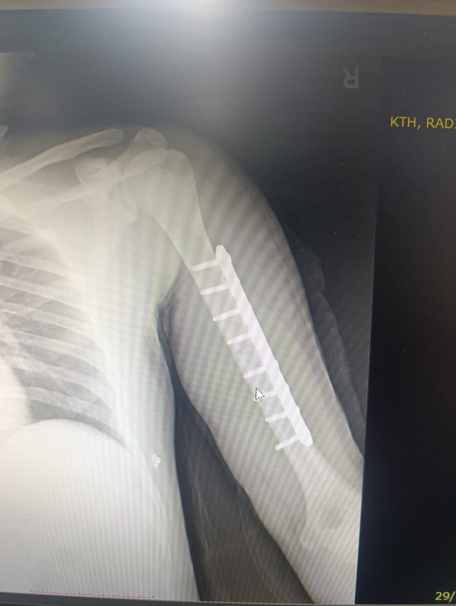 DoctorWoctor_'s tweet image. Some bone fixation 🙄
#Orthopedics #Trauma #InterlockingNail #Femur #Humerus