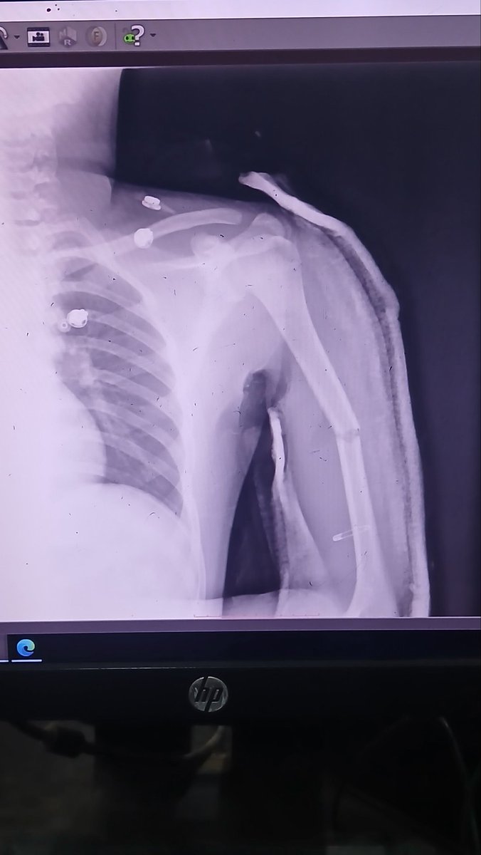 DoctorWoctor_'s tweet image. Some bone fixation 🙄
#Orthopedics #Trauma #InterlockingNail #Femur #Humerus