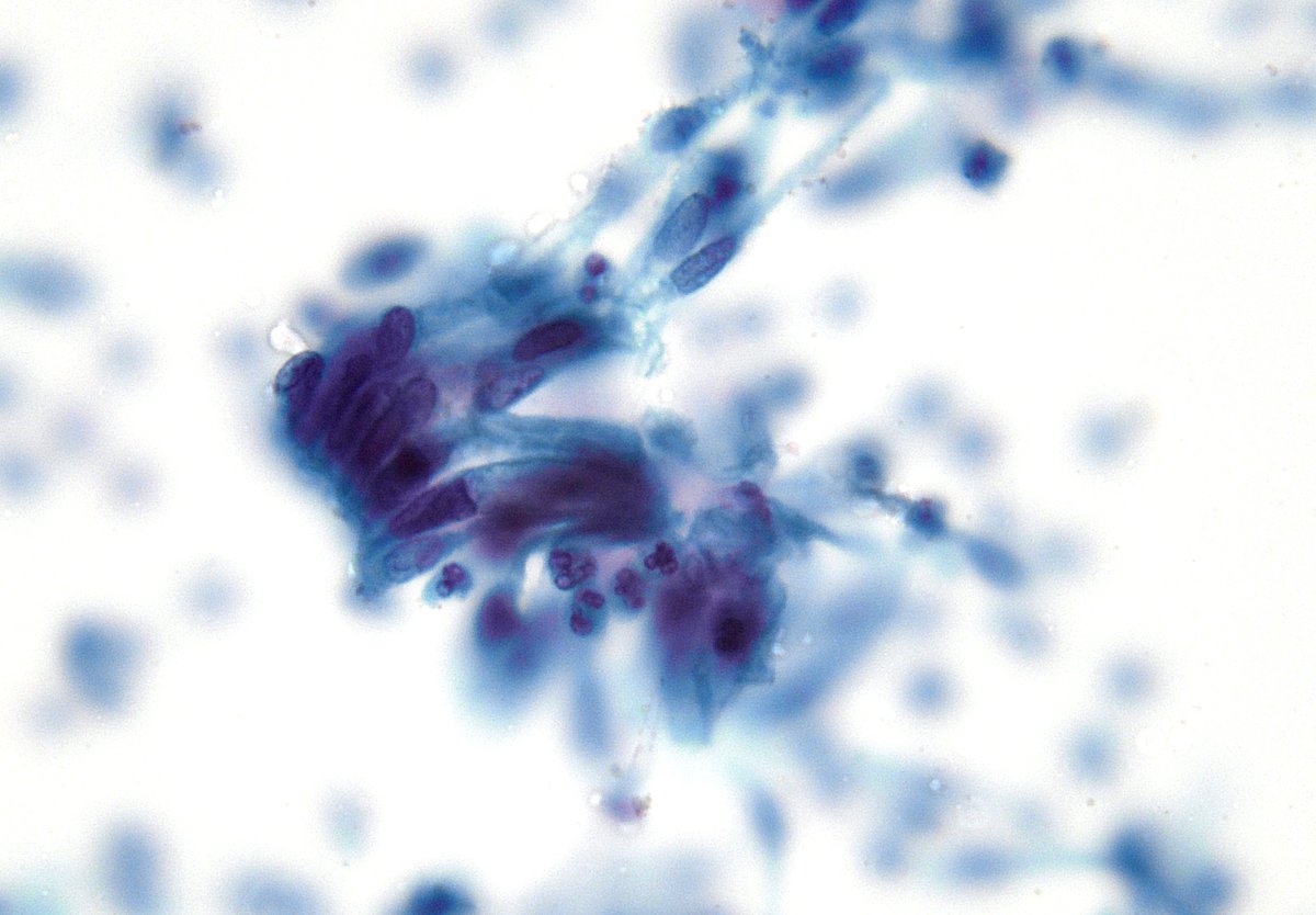 A disorganized "picket fence". I find endocervical AIS to be one of the most challenging diagnoses in GYN PAP test. (SurePath)