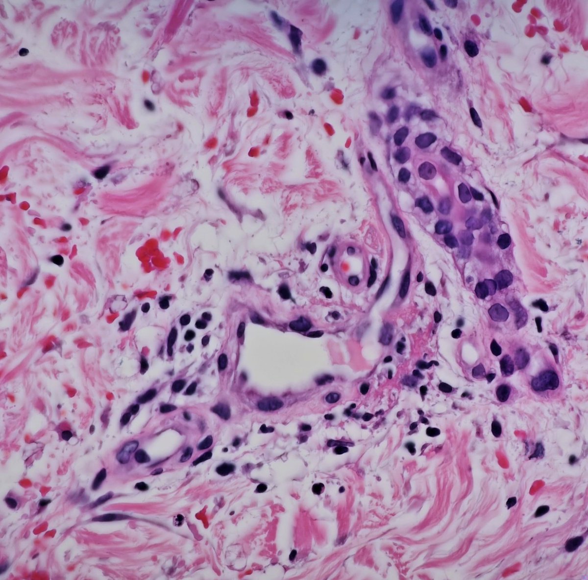 Always a good idea to do deepers if your dermatologist suspects vasculitis and u only c 🔴 cell extravasation with subtle PV inflammation. Tiny focus of #FibrinoidNecrosis on level 25! 
#dermatology 
#pathology 
♥️