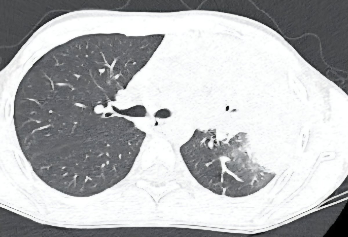 draceciferrario's tweet image. How often have you seen pediatric pneumonias extending to the chest wall? 🤔

#Radiology #PedsRad #CT #MedTwitter