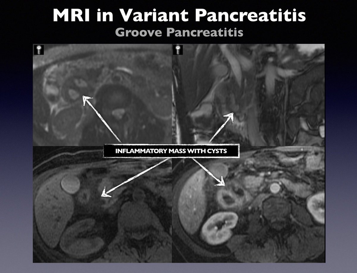 <a href="/CasesCookyJar/">Cases From the Cooky Jar</a> <a href="/cookyscan1/">Cooky Menias</a> <a href="/RadioGraphics/">RadioGraphics</a> Companion case!!! Time travel… RSNA Educational Exhibit from 12 years ago…
