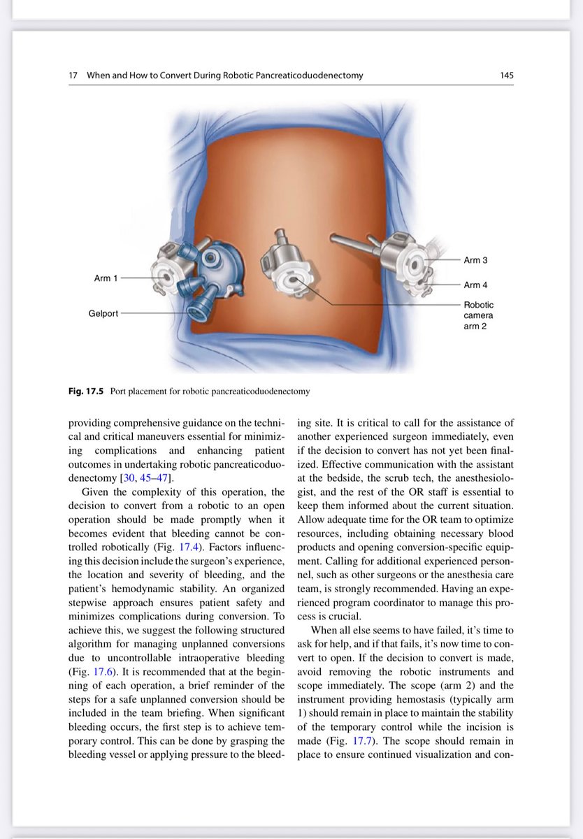 RossSharona's tweet photo. 📚 Excited to share a significant milestone in the field of pancreatic Surgery! This comprehensive book focuses on the minimally invasive Whipple procedure for pancreatic cancer, showcasing the groundbreaking advancements of the robotic approach. I am both honored and grateful to have contributed to this remarkable work, which I believe will shape the future of pancreatic Surgery.

A special shoutout to my fellow, Dr Emanuel Shapera, for authoring one of the chapters alongside my dear friend, Dr. Ahmad Abou Abbass. Their contributions highlight the collaborative spirit within our community.

#roboticsurgery #pancreaticcancer #medicaladvancements #AdventHealth @AdventHealth @AdventHealthWFL @AdventHealthCFL @AdventHealthKC @AdventHealth_NC @BayCare @HCAhealthcare @orlandohealth @MoffittNews @TGHCares @USFHealth @USFHealthMed @UCFHealth @UF @IntuitiveSurg @PancreaticCanUK @P_C_E_ @OfficialPCA @PanCAN @PanCANTampaBay #innovation #surgery #minimallyinvasivesurgery #technology
