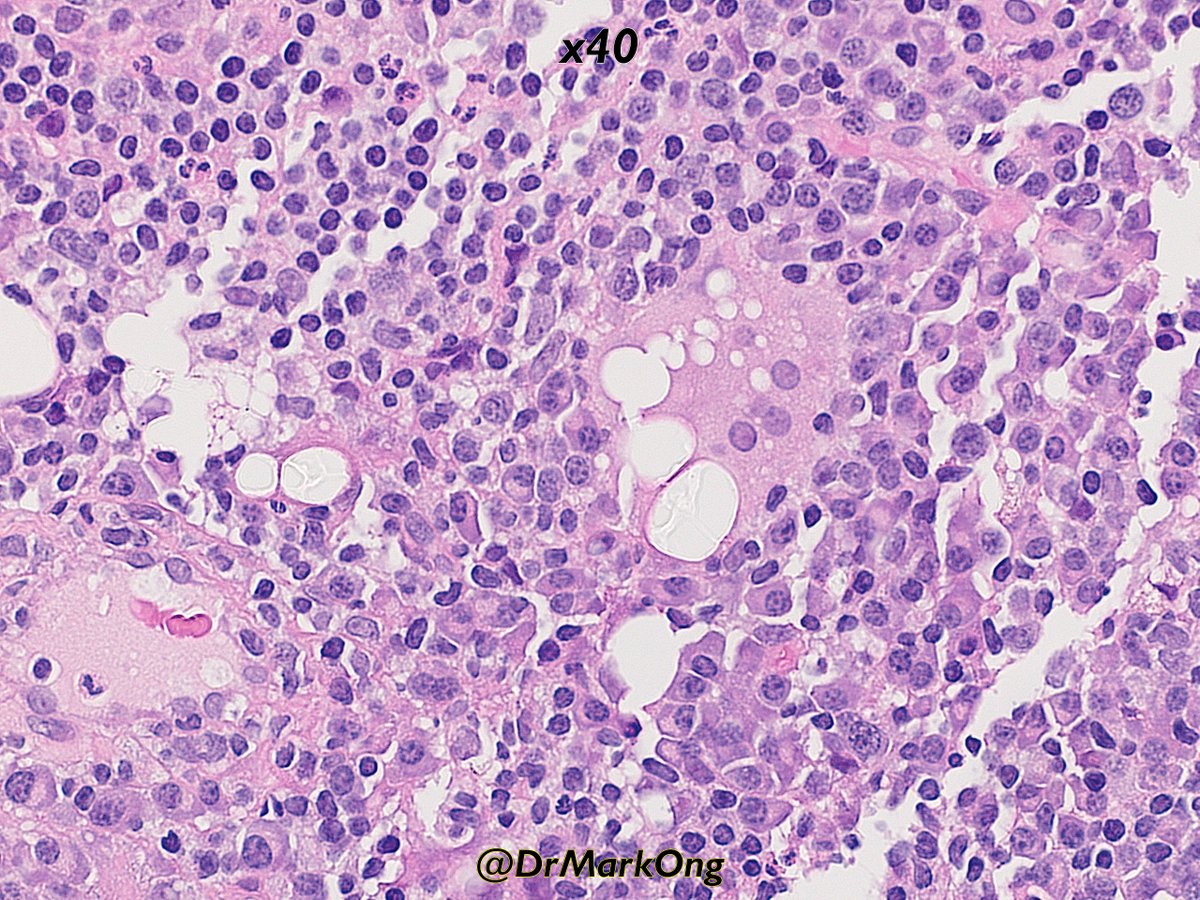 DrMarkOng's tweet photo. Silicone granulomata in axillary lymph node (breast implants).

Note the translucent refractile, but not birefringement, material in pictures 3 and 4. Often easier to see by flipping the condenser out of the way.

#hemepath #pathtwitter #pathology https://t.co/bbSTAkMZe1