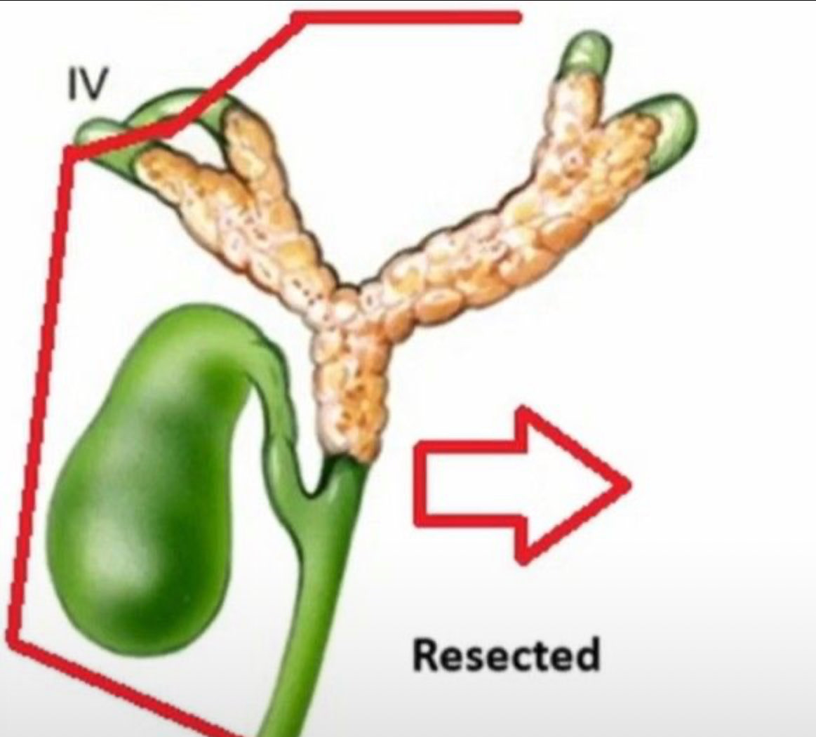 IswantoSucandy's tweet photo. Sharing our robotic surgery technique for Type IV perihilar cholangiocarcinoma. This is the most complex hepatobiliary resection undertaken via robotic surgery at this time. Refer to our paper on the Annals of Surgical Oncology:

https://t.co/qTFj8fHNWx

https://t.co/R28LhW9Zmn https://t.co/JIfHN7VR3x