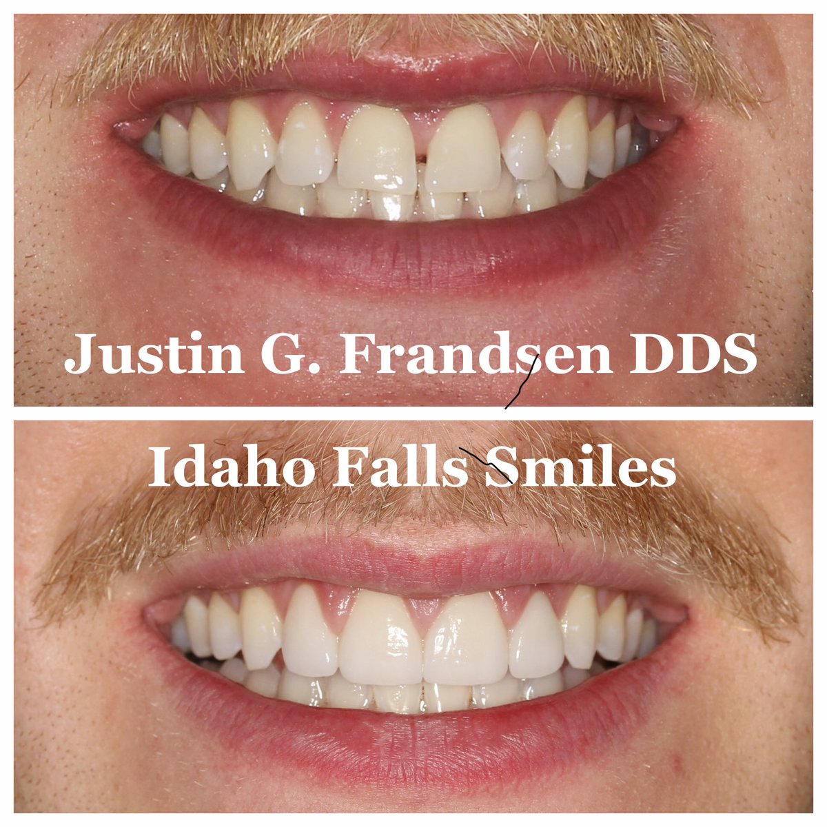 FrandsenDDS's tweet photo. Cosmetic cases.  If you hesitate to smile because of the appearance of your front teeth, it’s time for an enhancement.  Four ceramic veneers for this case to close spaces, level the teeth and add symmetry to the smile.  Confidence upgrade ✅. https://t.co/Y2hdIpAnrB