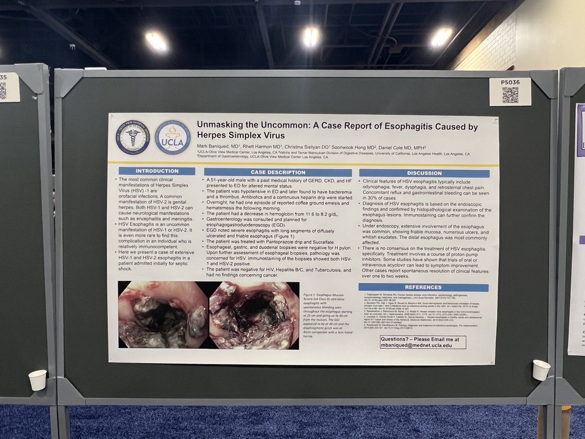 Markets_MD's tweet photo. My posters for ACG2025! Thank you to my colleague, Dr. Rhett Harmon, for presenting our work in my absence from this year's conference. Hoping to make it out to Nashville next year! 

@AmCollegeGastro @UCLAGIHep #ACG2025 https://t.co/0hF0uiJiIE
