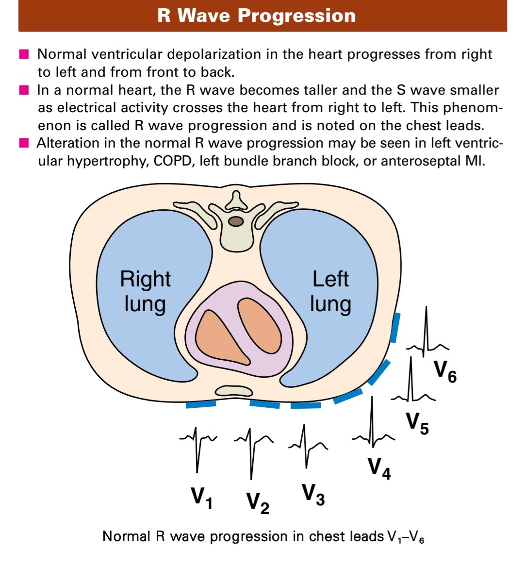 TrackYourHeart's tweet image. R wave progression 😍#ECG