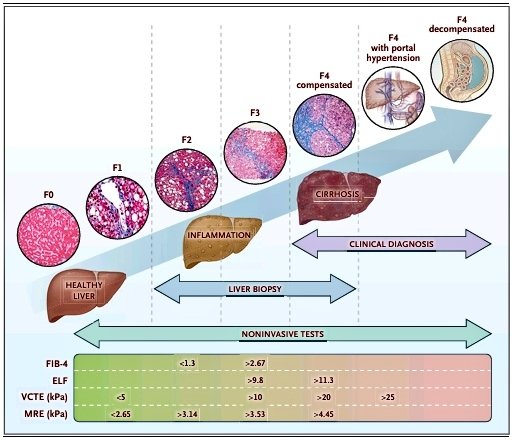 Evaluación no invasiva de la fibrosis hepática. NEJM
nejm.org/doi/10.1056/NE…
<a href="/SociedadSeedo/">SEEDO</a> <a href="/EHMETSEEN/">EHMETSEEN</a> <a href="/Diabetes_SEMI/">GT-SEMI Diabetes, Obesidad y Nutrición #17DM_SEMI</a> <a href="/gt_rcv/">GT Riesgo Vascular SEMI</a> <a href="/MHcsba/">Medicina Interna HCSBA</a> <a href="/Sociedad_SEMI/">#46SEMI Sociedad Española de Medicina Interna</a>
 <a href="/drshafikuchay/">M Shafi Kuchay</a> <a href="/feralcivarmd/">Fernando Alcívar</a>