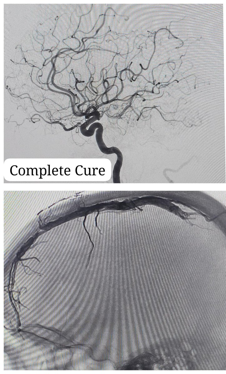 SharathKumarGG7's tweet photo. Case of Cerebral Dural Arteriovenous Fistula! Admitted 3 times elsewhere with recurrent drug resistant seizures without any definitive diagnosis. Referred for diagnosis & further care @ManipalHealth
Happy to give definitive treatment & diagnosis! #Davf #Neuroradiologist https://t.co/aYrt9dxsRy