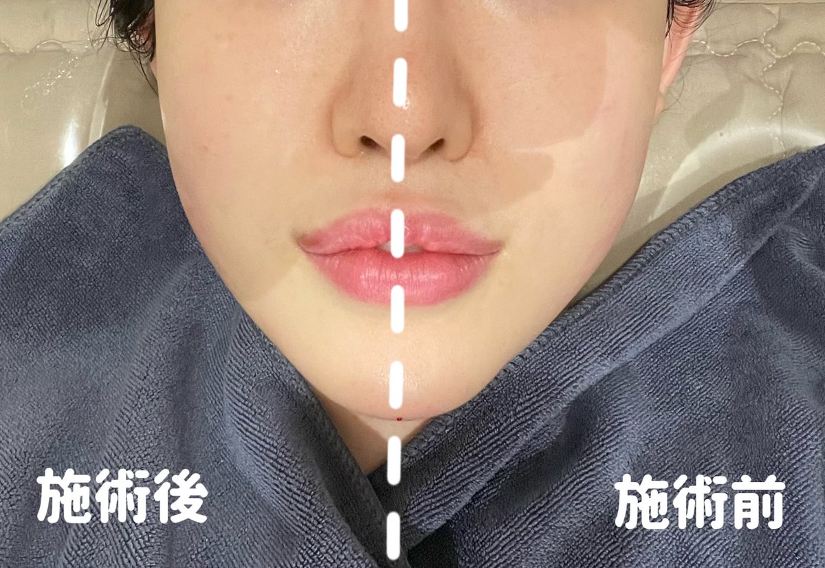 渡韓整形🇰🇷ごりちゃん (@_goriosan_) on Twitter photo 🇰🇷ドクタープチ明洞店でチタニウムリプトと顎ボトックスを施術しました!
施術前にスタッフの方が丁寧に顔のクレンジングをしてくださいます。
チタニウムリフトをしてすぐ引き締まった感じを実感!(画像2枚目)美白効果も出てくるのがこれから楽しみです!明洞なので観光ついでの施術も良いですね◎ 🇰🇷ドクタープチ明洞店でチタニウムリプトと顎ボトックスを施術しました!
施術前にスタッフの方が丁寧に顔のクレンジングをしてくださいます。
チタニウムリフトをしてすぐ引き締まった感じを実感!(画像2枚目)美白効果も出てくるのがこれから楽しみです!明洞なので観光ついでの施術も良いですね◎