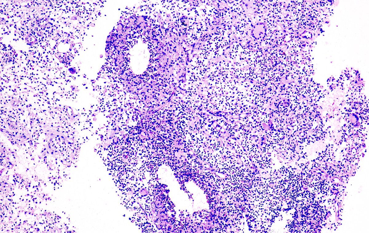 SumantaDas_7's tweet photo. Female in 40s. Breast abscess. 
Lobulocentric mixed inflammatory infiltrate
Cystic spaces (lipid vacuoles) rimmed by neutrophilic microabscess &amp; Non-necrotizing epithelioid cell granulomas
#PathTwitter #PathX #BreastPath #PathClassic https://t.co/N0DxhsHU78