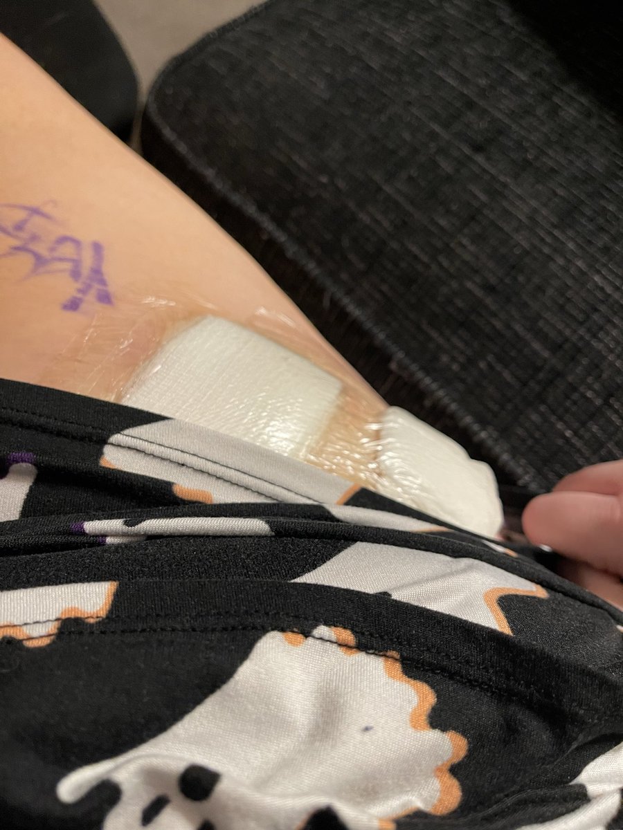 KearHD's tweet image. I’m home, surgery went great. They had to put 4 anchors in and round off my femurhead. Now to get back to normal! #FAIsurgery #hiparthroscopic #recoverytime 💪🏻